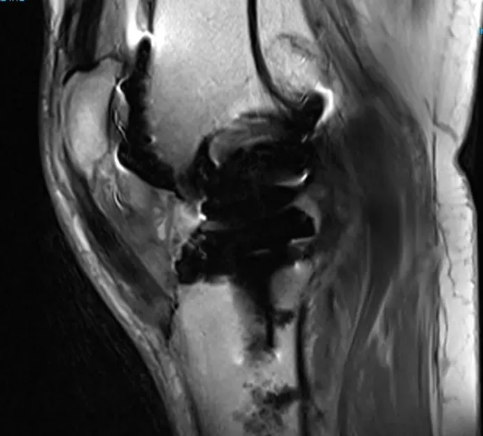 Is it safe to have an MRI after hip or knee replacement surgery?