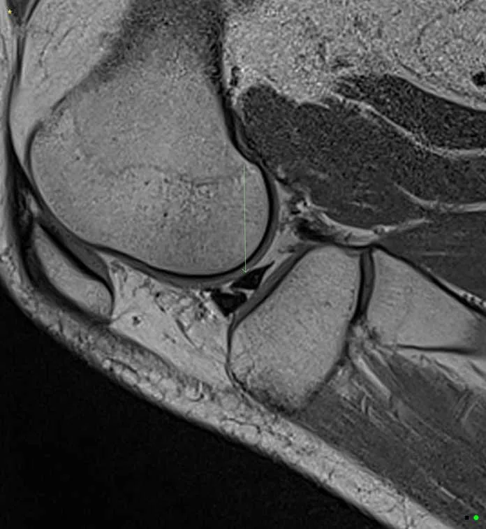 MRI OF THE RIGHT LOWER LEG PRE AND POST CONTRAST