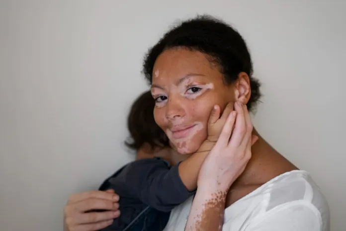 Living With Vitiligo: Myths And Confidence