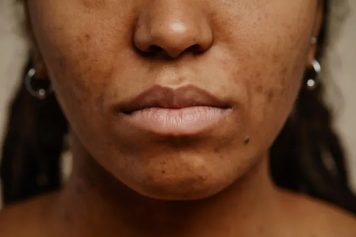 What Causes Petechiae? When Tiny Red Spots Could Be a Sign of Something Serious